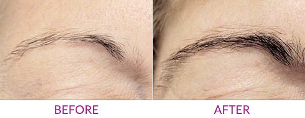 Before and after image results for RapidBrow