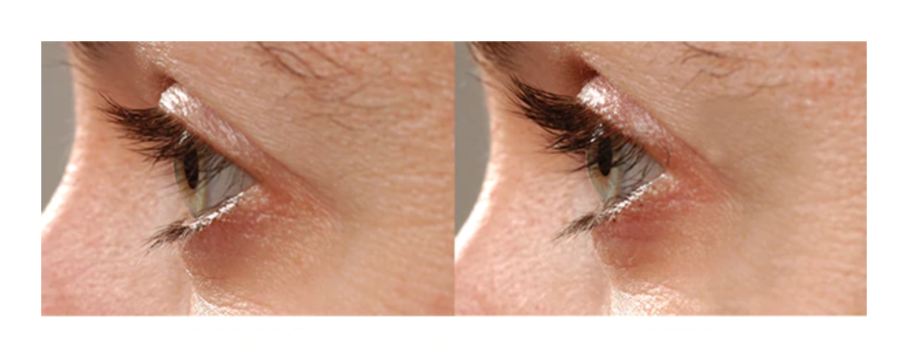 Before and after image results of RapidLash® Eyelash Enhancing Serum